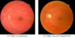 GLAUCOMA 2